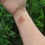 Poison Oak/Poison Ivy Rash: Contact Dermatitis